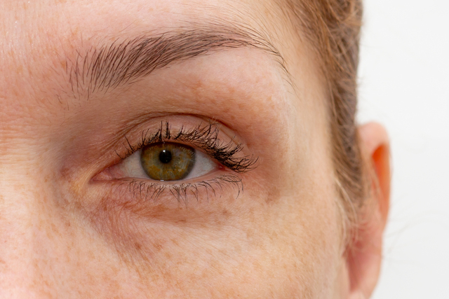 Woman eye blind spot injury from plaquenil