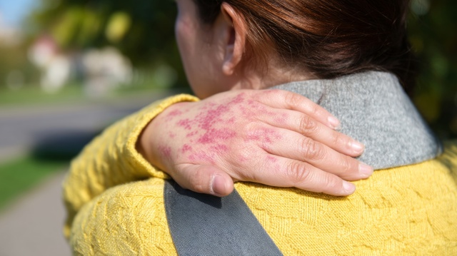 Lupis and Plaquenil showing on a woman's hand - Should I take the medication